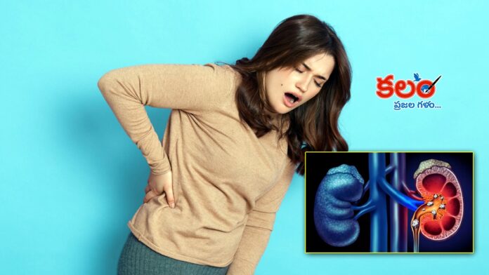 Kidney Stones