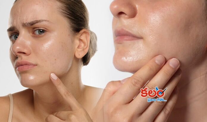 Oily Skin Remedies