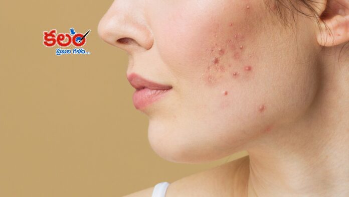 Pimple Removal Tips