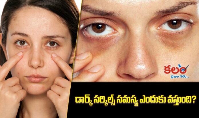 Dark Circles Causes