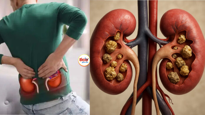 Kidney Stones